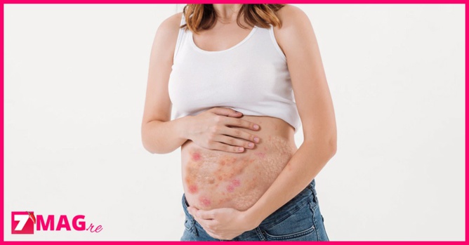 Cette femme enceinte est allergique à son bébé Cette femme enceinte est allergique à son bébé