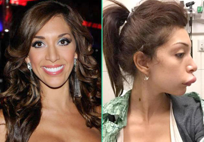 Farrah défigurée après une injection! Farrah défigurée après une injection!