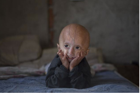 Le drame de l'enfant-vieillard