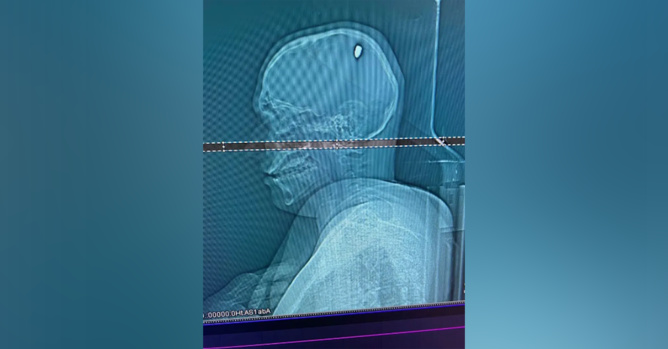 Un étudiant fait la fête pendant 4 jours avec une balle logée dans le crâne Un étudiant fait la fête pendant 4 jours avec une balle logée dans le crâne