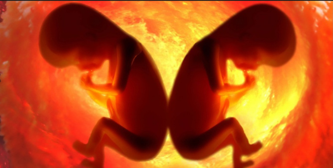 Jumeaux sains à l'état foetal Jumeaux sains à l'état foetal