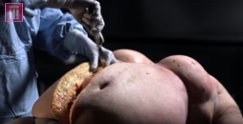BBC: La violente autopsie d’une femme obèse contre le surpoids (Vidéo choc)