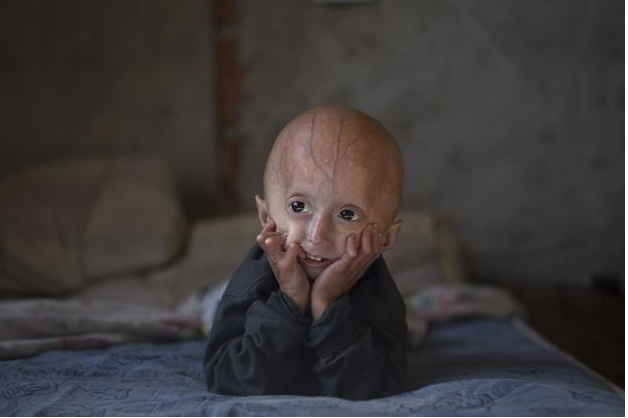 Le drame de l'enfant-vieillard