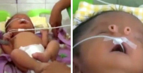 Un petit garçon naît sans nez mais avec deux petites trompes