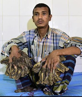 L'homme-arbre va enfin être opéré!