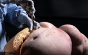 BBC: La violente autopsie d’une femme obèse contre le surpoids (Vidéo choc)