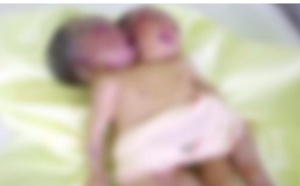 Naissance de siamoises à l'île Maurice