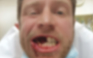 Il perd 3 dents dans l'explosion de sa cigarette électronique