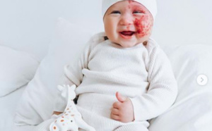 Les parents font enlever les taches de naissance de leur bébé: les internautes les insultent