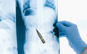 Il arrive aux urgences avec un obus antichar très mal placé