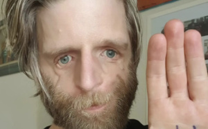 L’histoire de Jono Lancaster né avec le terrible syndrome de Treacher Collins