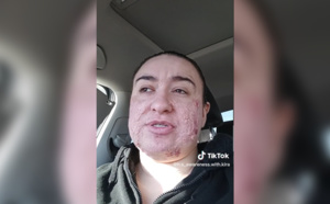 Atteinte d'une maladie de la peau elle sensibilise TikTok