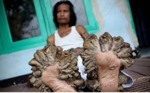 Le calvaire de l'homme-arbre de Java