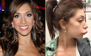 Farrah défigurée après une injection!