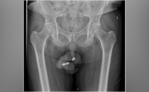 Il doit subir une greffe du pénis après s'être inséré 3 piles dans l'urètre
