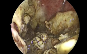 VIDEO : 150 larves de mouches vivantes retirées du nez d'un patient aux urgences