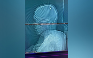 Un étudiant fait la fête pendant 4 jours avec une balle logée dans le crâne