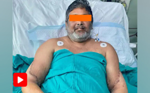 Un peintre amputé se fait greffer les bras d'une femme