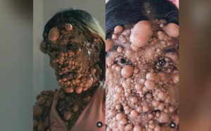 Couverte de tumeurs de la tête au pied, cette femme ne pouvait même plus respirer 