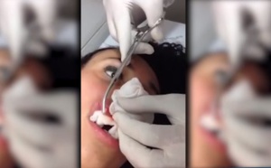 Le médecin extrait un ver de sa lèvre!