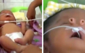 Un petit garçon naît sans nez mais avec deux petites trompes