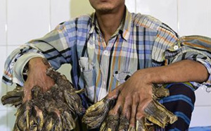 L'homme-arbre va enfin être opéré!